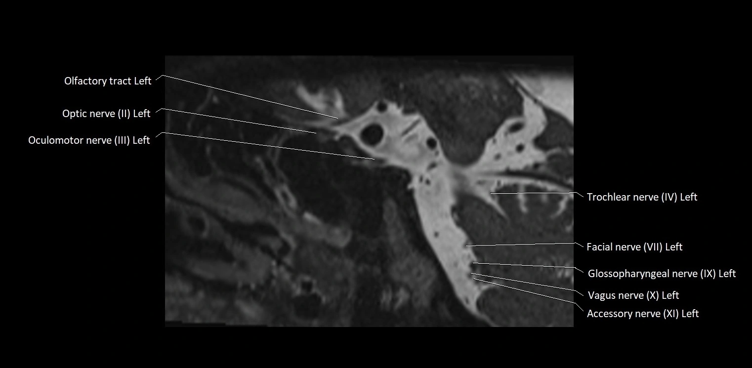 Cranial nerve sagittal anatomy MRI 3T image 23.webp